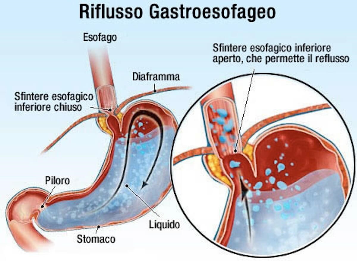 reflusso gastroesofageo