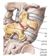 spondilolistesi