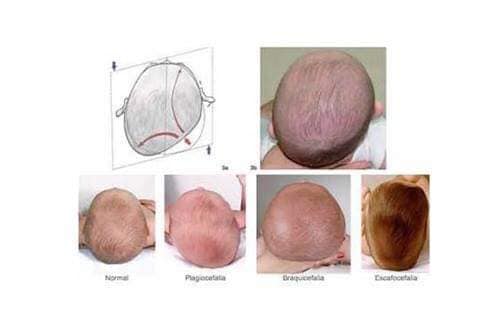 osteopatia pediatrica plagiocefalia